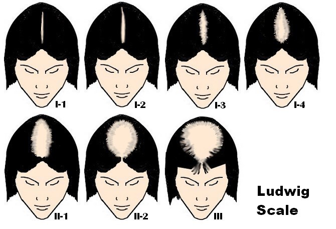 Female Hair Loss in Orlando, FL