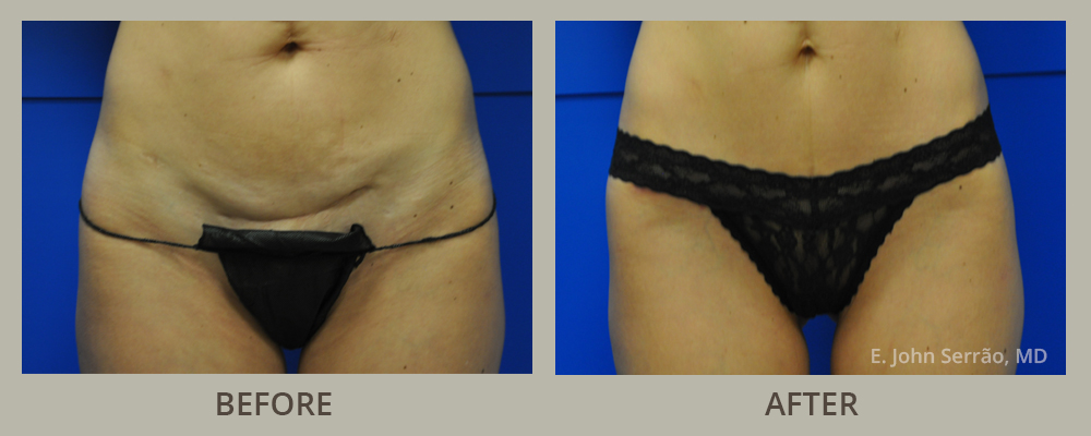 Tummy Tuck Before and After Pictures Orlando, FL