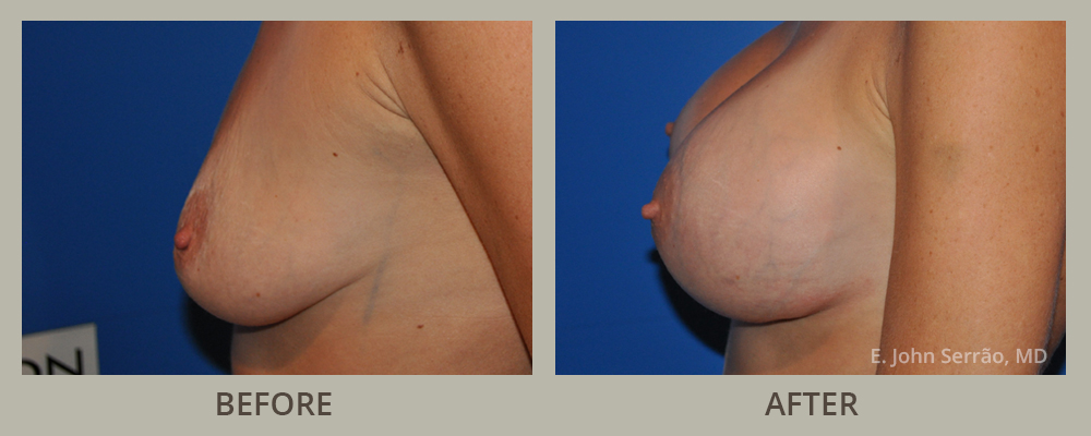 Breast Augmentation with Implants Before and After Pictures Orlando, FL