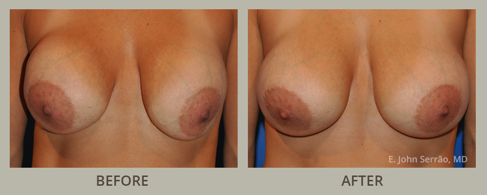 Breast Implant Revision Before and After Pictures Orlando, FL