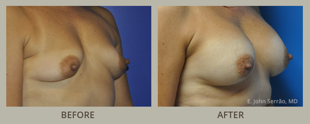Breast Augmentation with Implants Before and After Pictures Orlando, FL