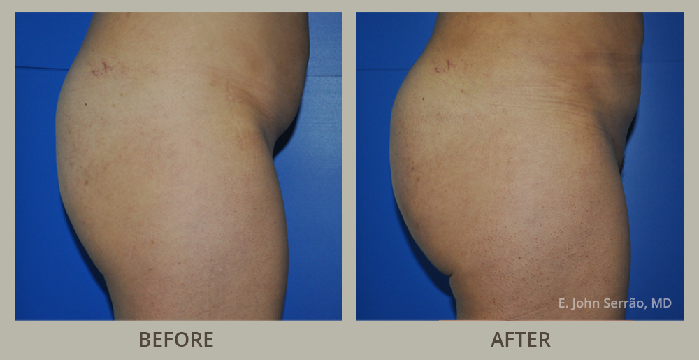 Brazilian Butt Lift Before and After Pictures Orlando, FL