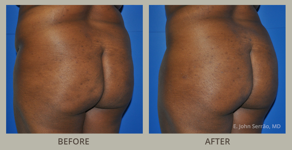 Brazilian Butt Lift Before and After Pictures Orlando, FL