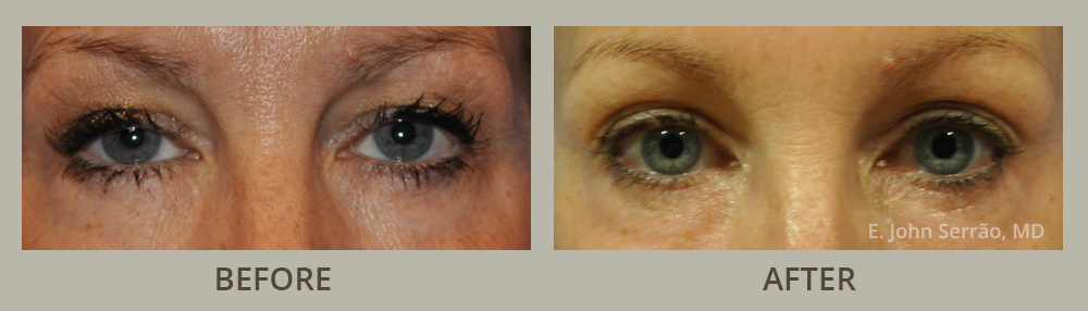 Non-Surgical Blepharoplasty Before and After Pictures Orlando, FL
