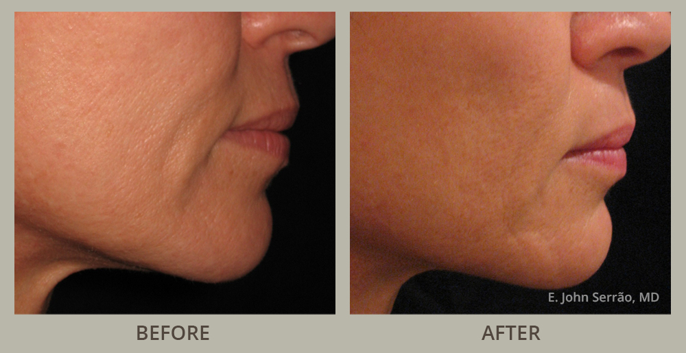 Facial Rejuvenation Before and After Pictures Orlando, FL