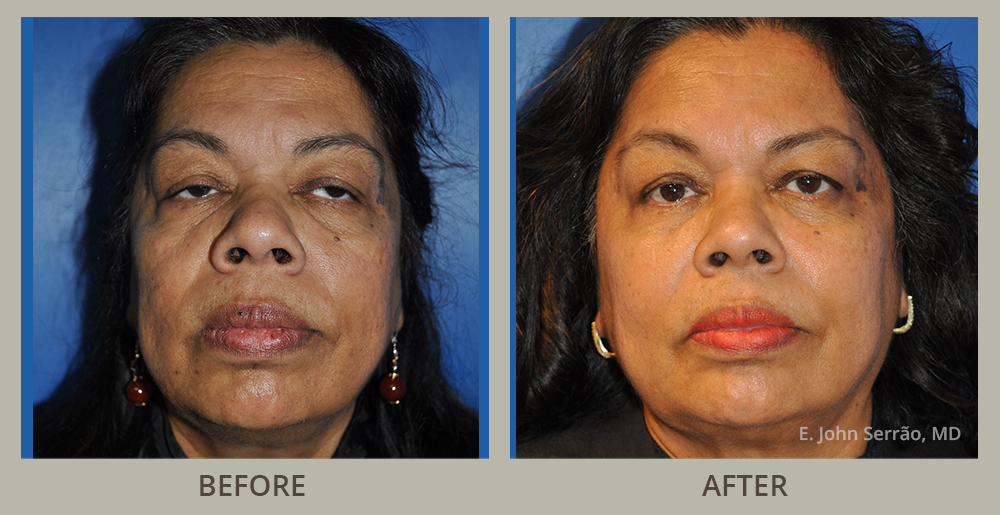 Facial Rejuvenation Before and After Pictures Orlando, FL
