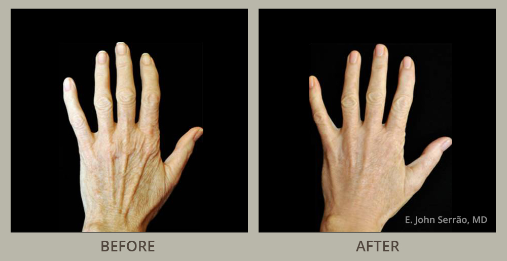 Hand Rejuvenation Before and After Pictures Orlando, FL