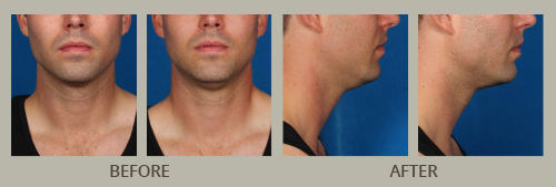 Chin & Neck Rejuvenation Before and After Pictures Orlando, FL