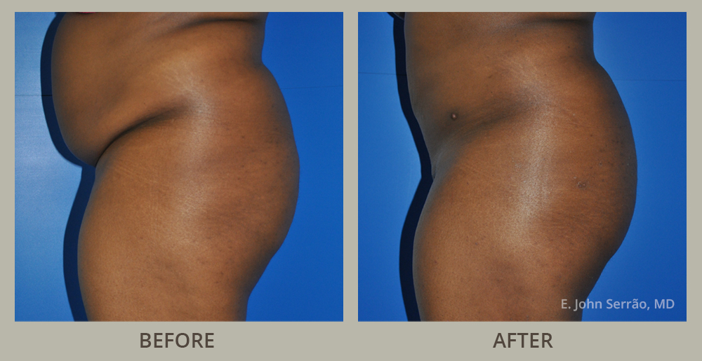 Liposuction Before and After Pictures Orlando, FL