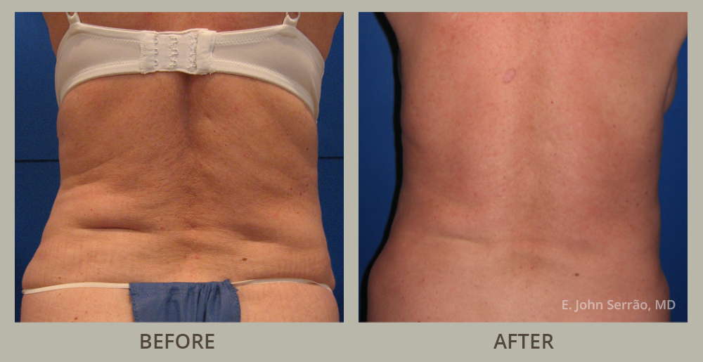 Liposuction Before and After Pictures Orlando, FL