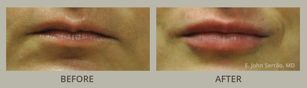 Lip Injections/Lip Rejuvenation Before and After Pictures Orlando, FL