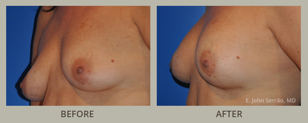 Breast Augmentation with Fat Transfer Before and After Pictures Orlando, FL