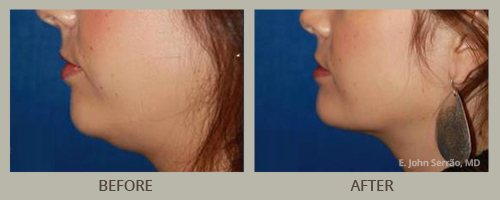 Chin & Neck Rejuvenation Before and After Pictures Orlando, FL