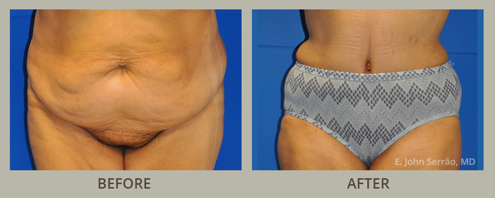 Tummy Tuck Before and After Pictures Orlando, FL