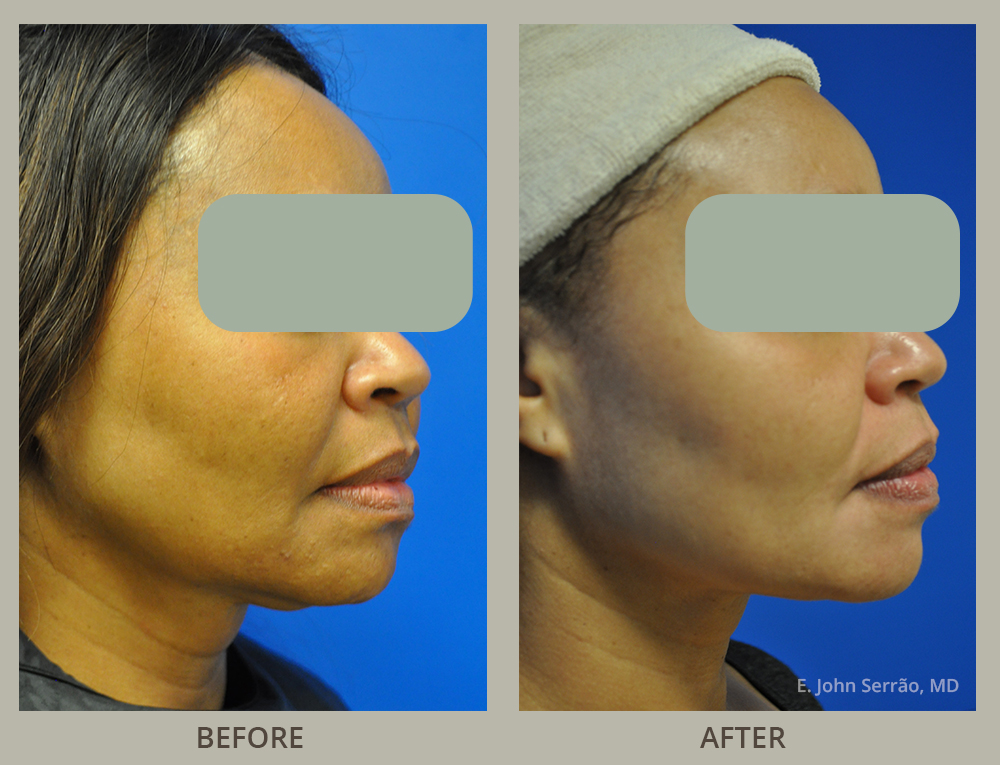 Non Surgical Face Lift Before and After Pictures in Orlando, FL